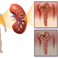 Kidney Damage and Nephropathy: The Long-term Complications of Type 2 Diabetes